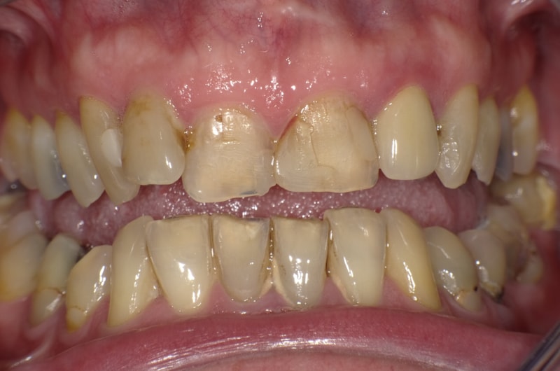 Sehr unzufriedener Patient, der immer wieder Reparaturen mit Kunststoff und einzelnen Kronen bei seinem langjährigen Zahnarzt bekommen hat